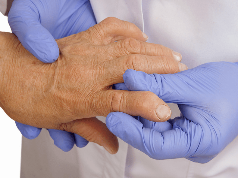 Der Arzt untersucht die Hand auf Schmerzen in den Fingergelenken