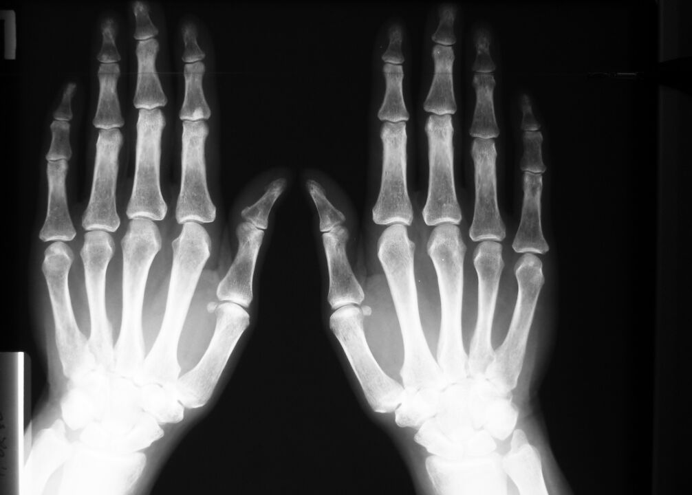 Röntgen zur Diagnose von Schmerzen in den Fingergelenken