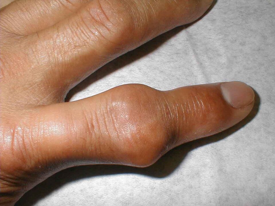 Tophi im Fingergelenk als Schmerzursache